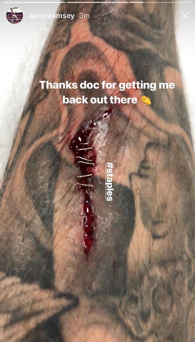 Рэмси показал рану на ноге, полученную в матче с ЦСКА - изображение 1