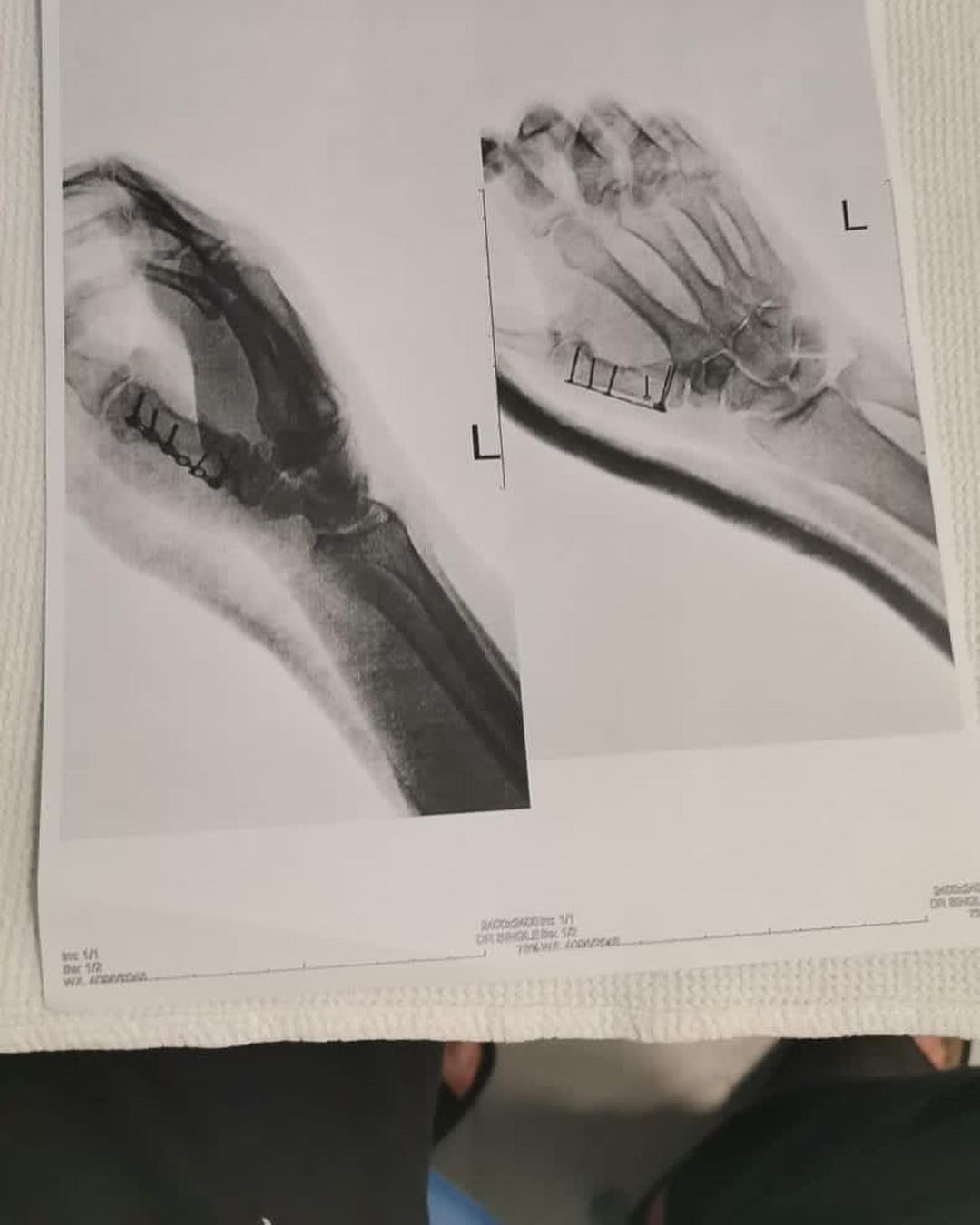 дацик травма руки