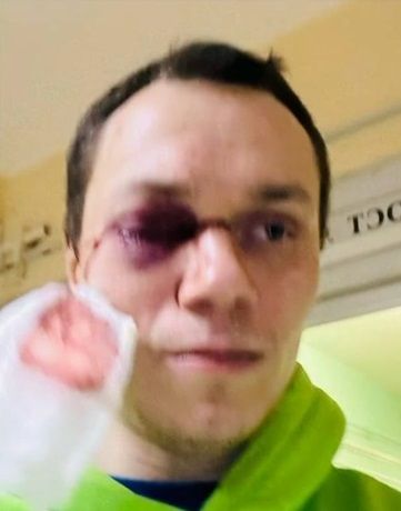 Корней Тарасов потерял глаз