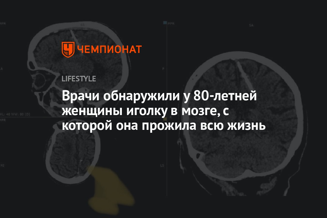 Врачи обнаружили у 80-летний женщины иголку в мозге, с которой она прожила  всю жизнь - Чемпионат