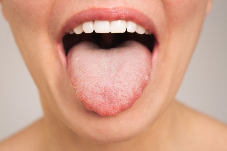«Зубчатый» язык может быть признаком болезни